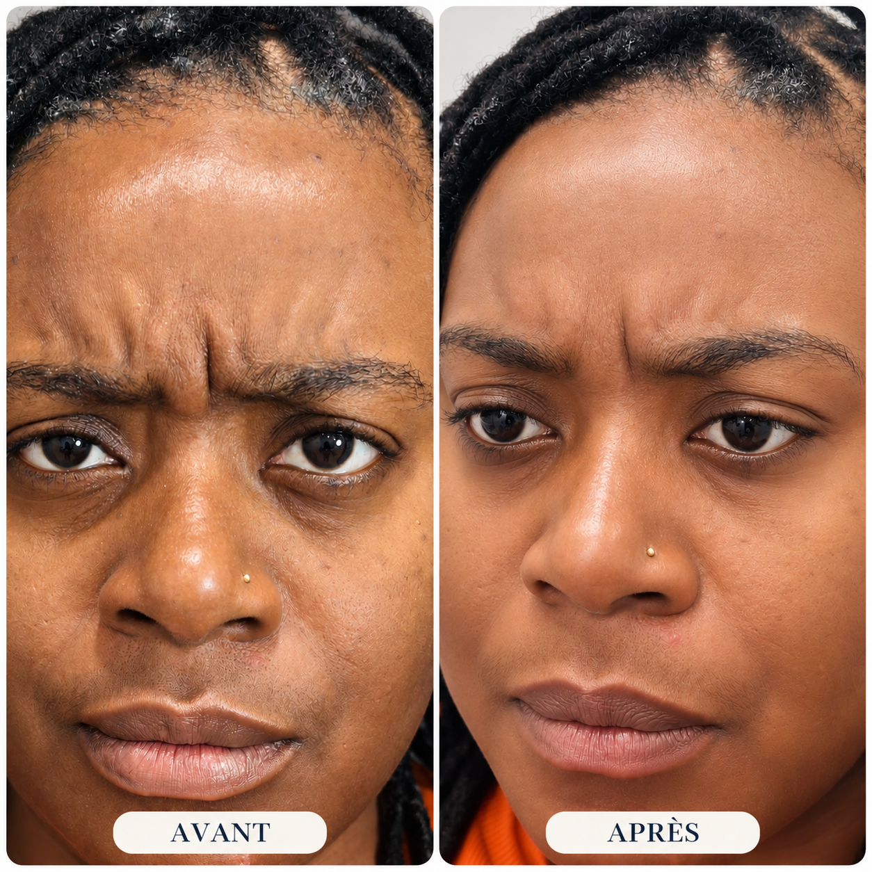 Comparaison avant et après montrant l’apparence de la peau et des rides d’expression du front