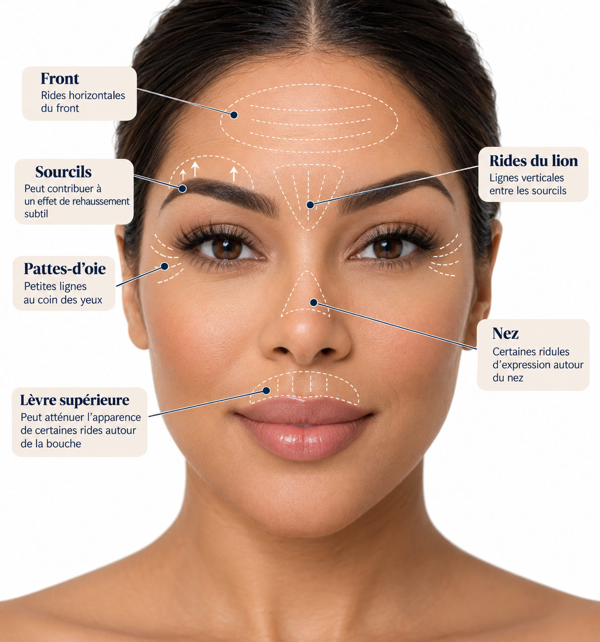 Zones du visage pouvant être traitées au neuromodulateur : front, rides du lion, pattes-d’oie, sourcils, nez et lèvre supérieure